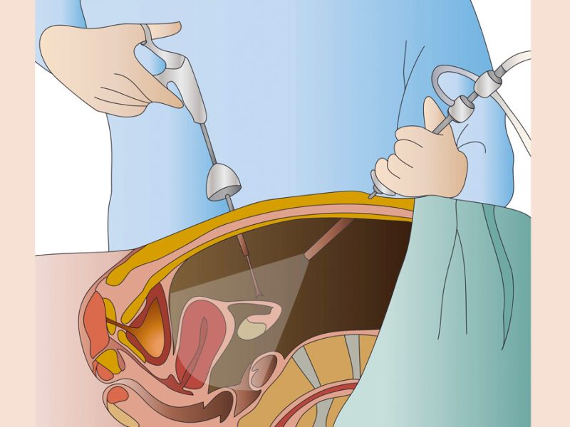 cirugia-laparoscopica