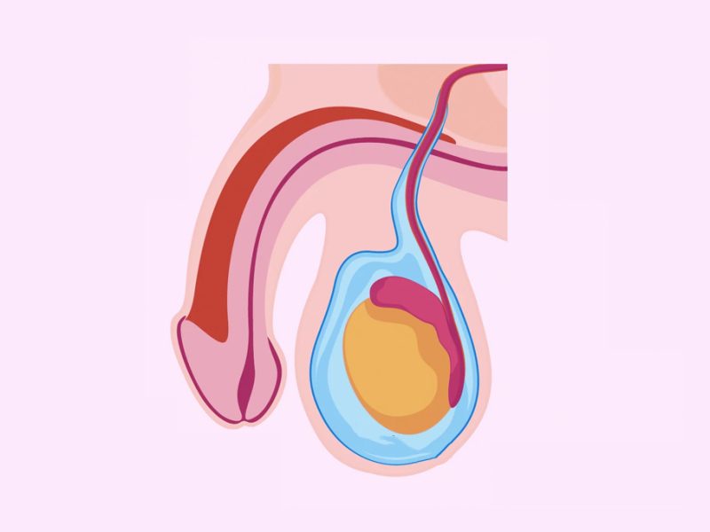hidrocele