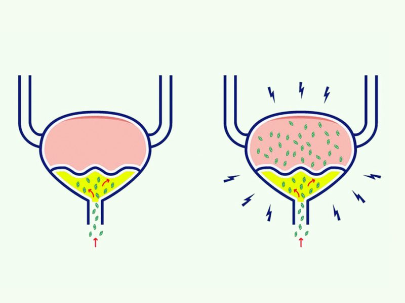 infeccion-urinaria