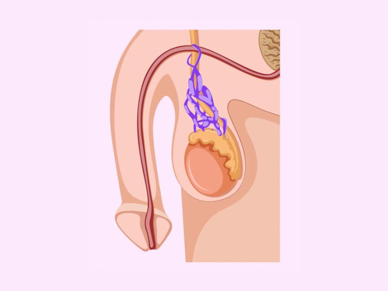 varicocele-2